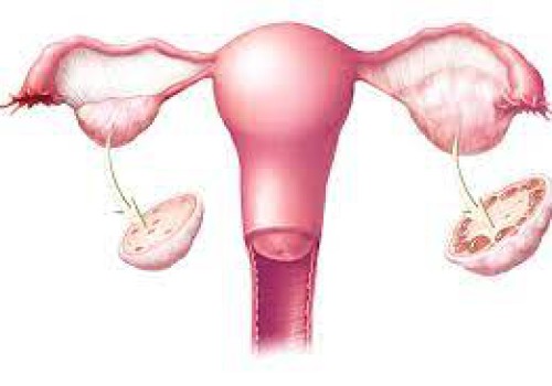 افزایش سرطان تخمدان در زنان مبتلا به سندرم تخمدان پلی کیستیک